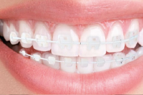 Ortodoncia Convencional Estética