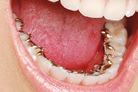 Ortodoncia Lingual - Incognito